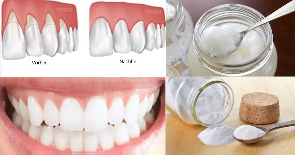 01-receding-gums-fb