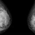 Schweizer Ärzteausschuss stoppt Mammographie-Screenings aus diesem schockierenden Grund!