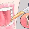 Dieses natürliche Mittel lässt deine Zahnschmerzen in wenigen Sekunden verschwinden