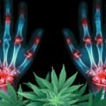 Cannabis bei Arthritis: Wie eine Pflanze verwendet wird, um Gelenkerkrankung zu heilen