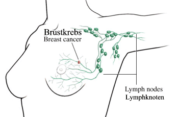 lymphe-brustkrebs