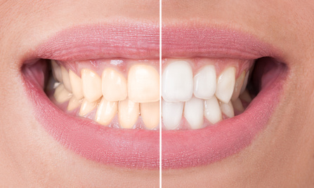 8 Wege Zähne auf natürliche Weise weißer zu machen